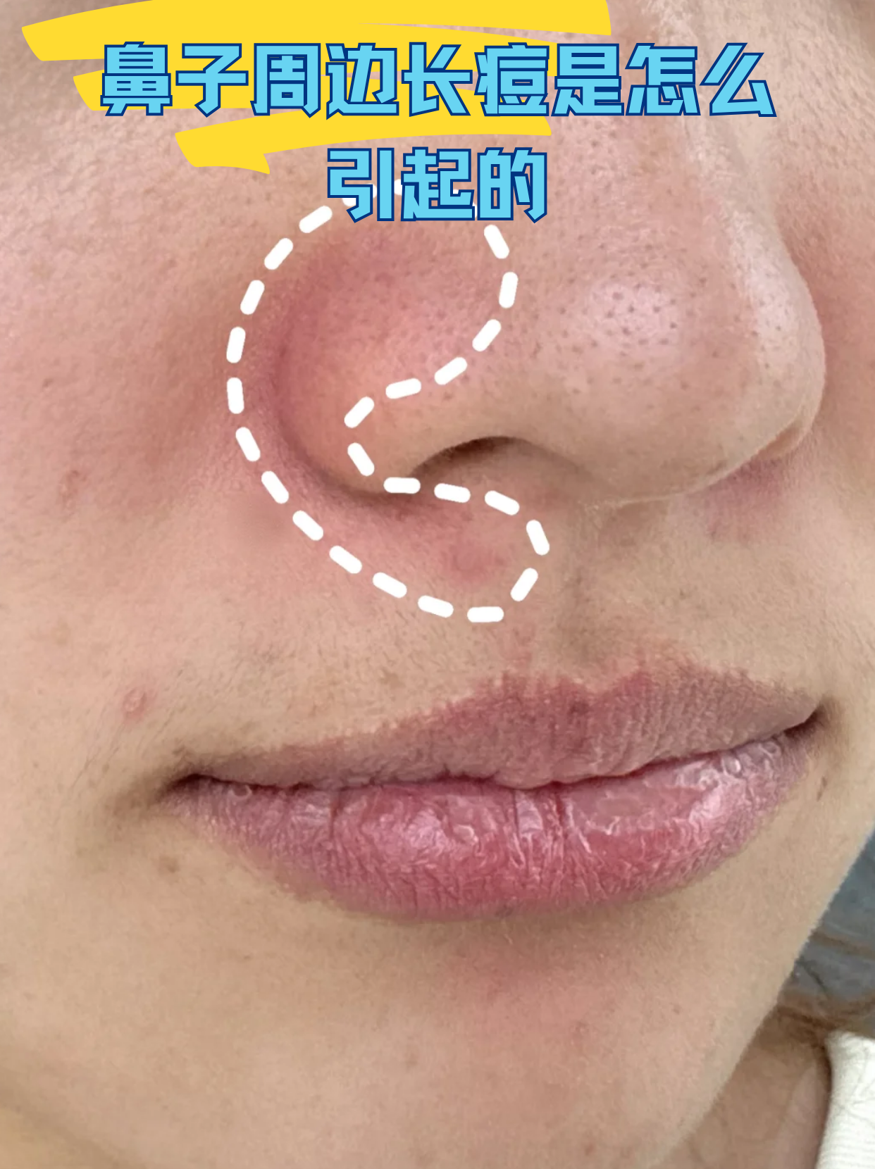 鼻子旁边长痘痘的原因