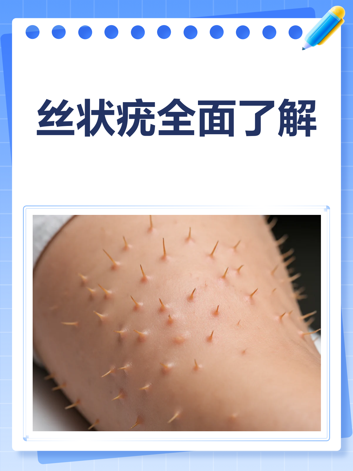 丝状疣是什么病?