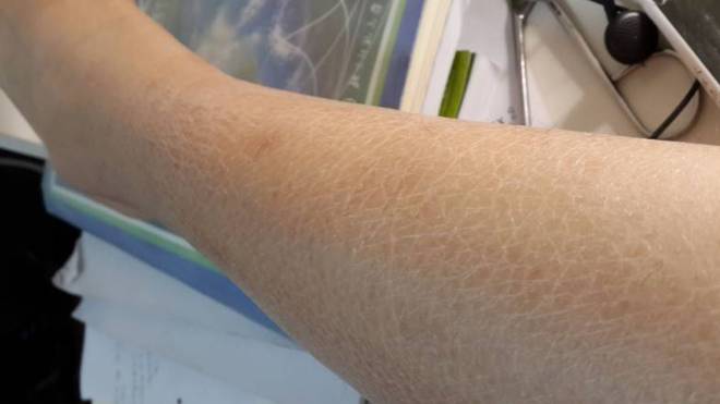 鱼鳞病到底能治好吗