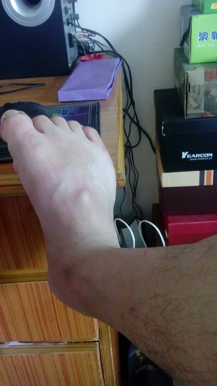 脚背上长了一个硬疙瘩