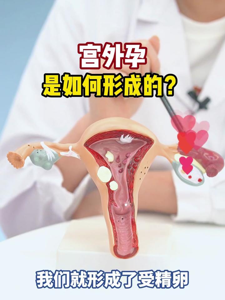 宫外孕是怎么引起的呢