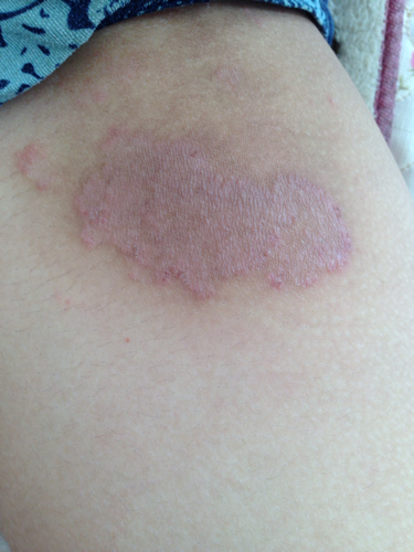 大腿内侧长一粒一粒的疙瘩,像被蚊子咬,很痒