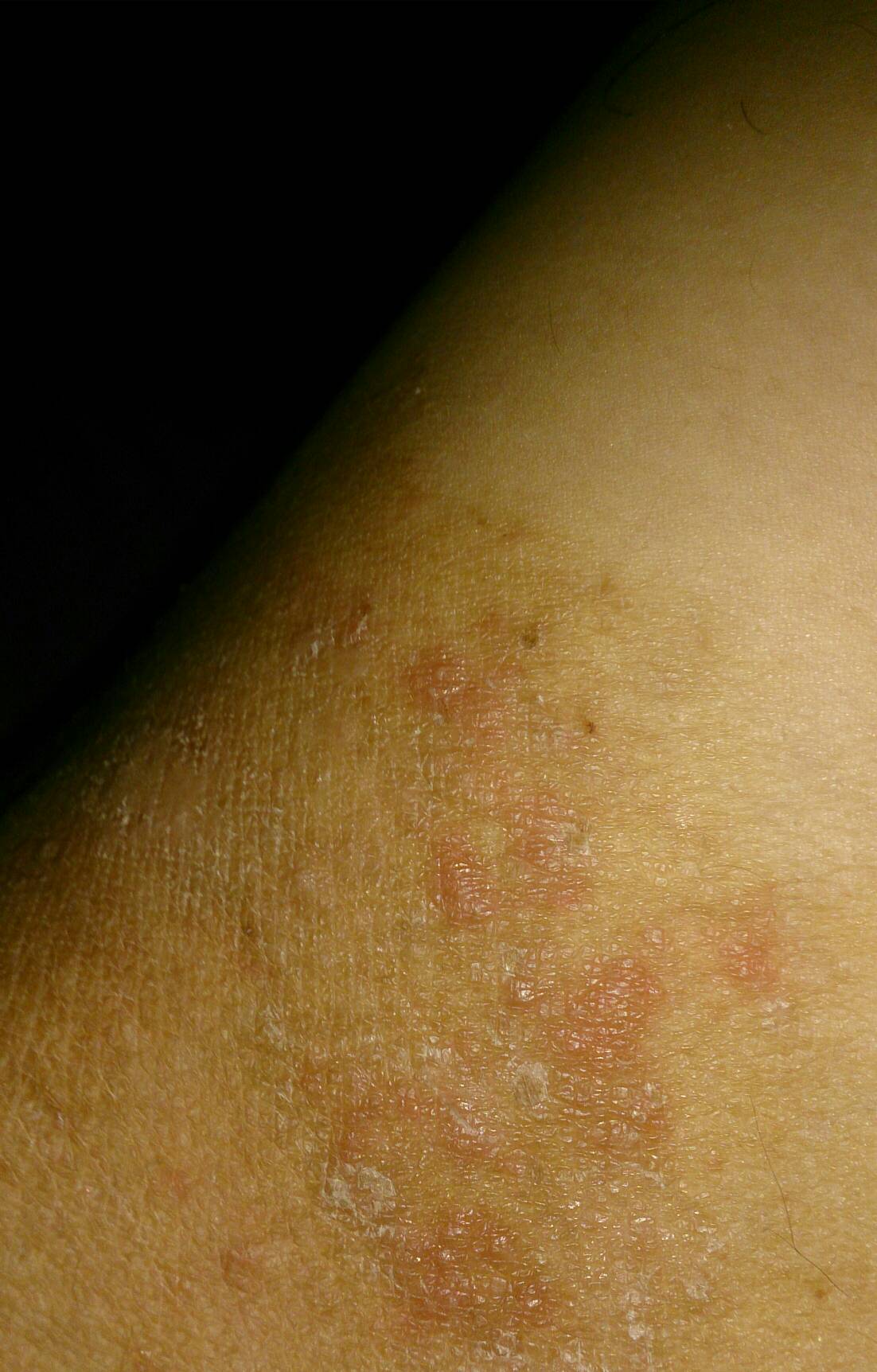 大腿内侧长一粒一粒的疙瘩,像被蚊子咬,很痒