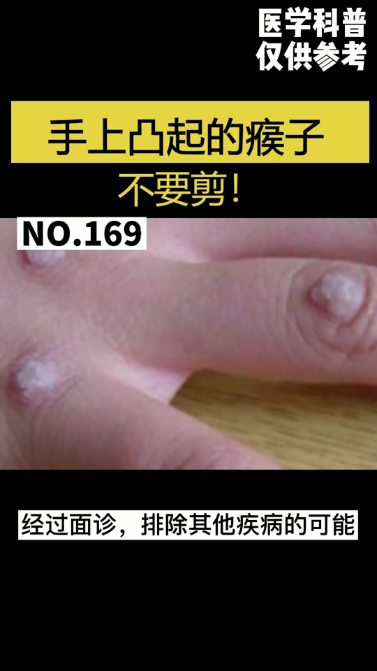 刺猴是怎么形成的