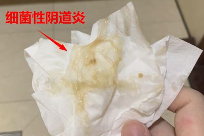 阴道炎的表现症状是什么?