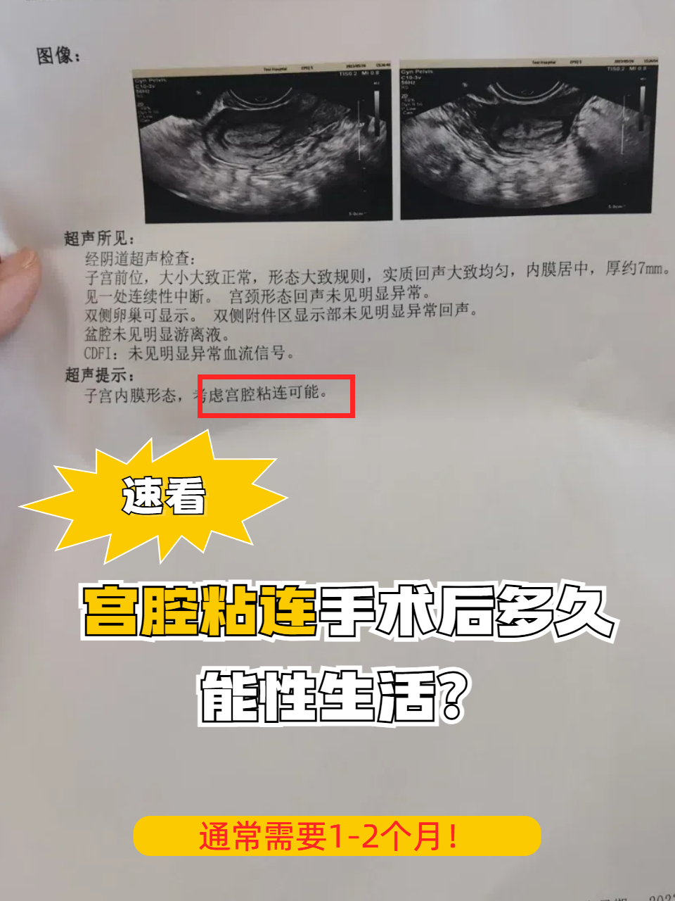 宫腔粘连怎样能检查出来