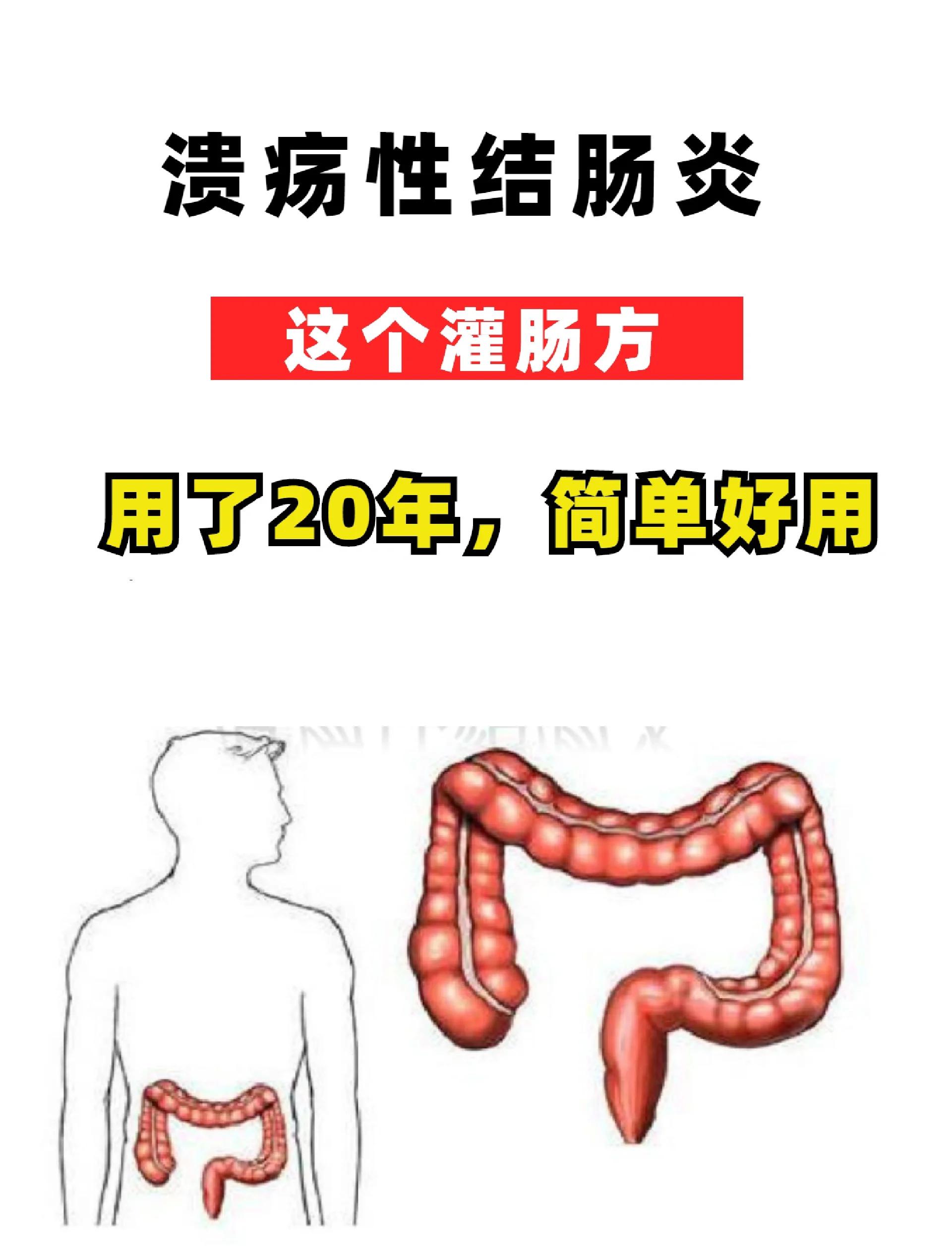 溃疡性结肠炎能治愈吗?