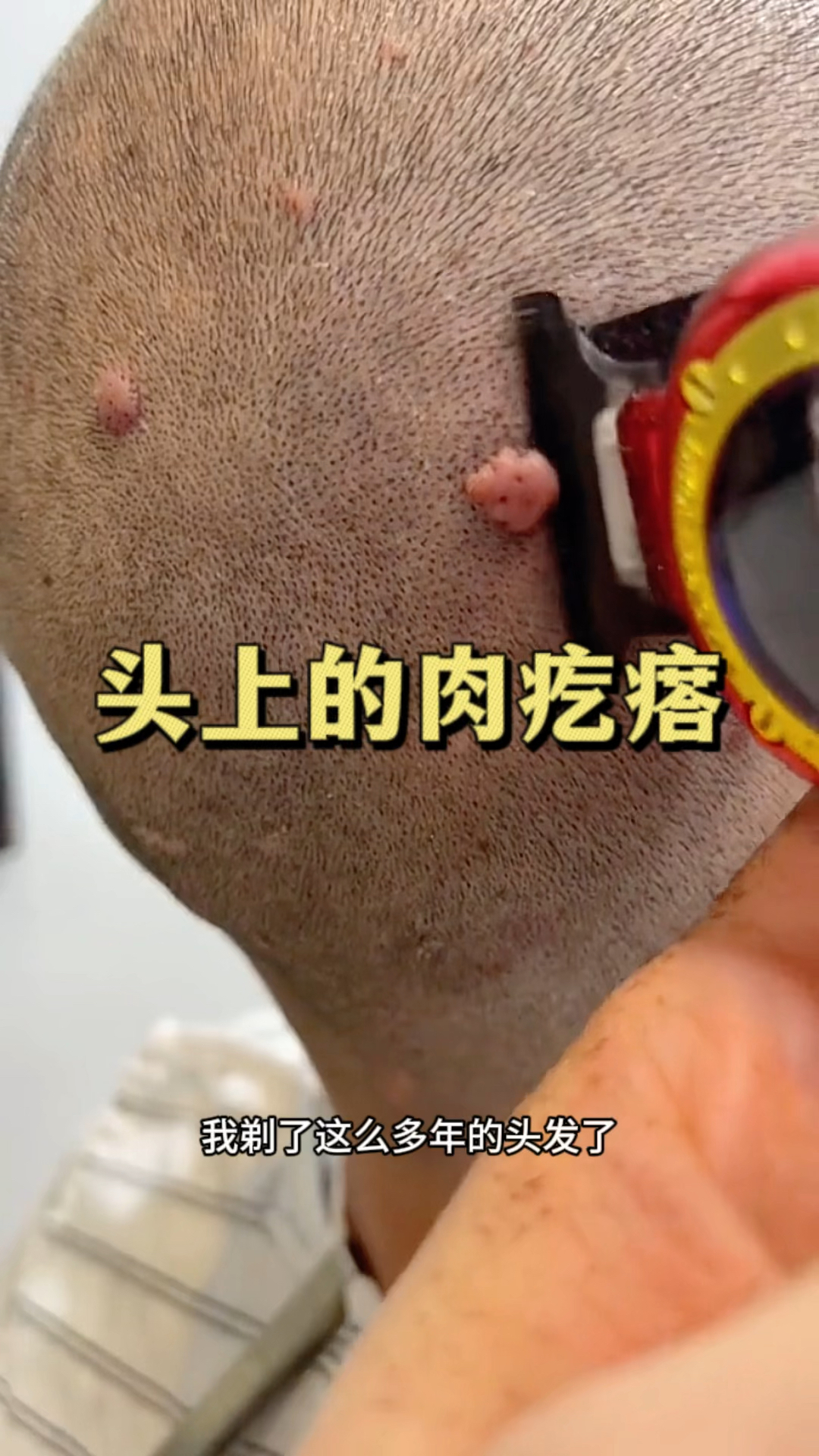 头皮上长了一块肉疙瘩