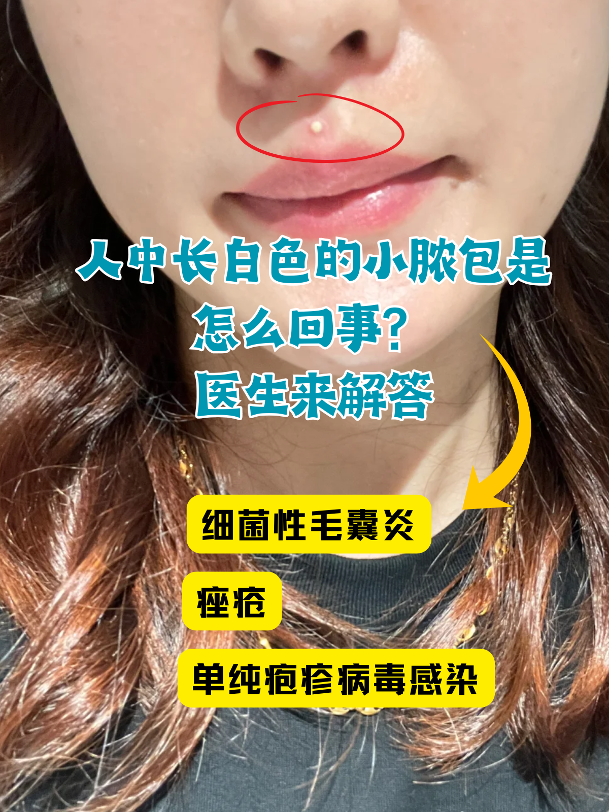 脸上长脓包怎么办?