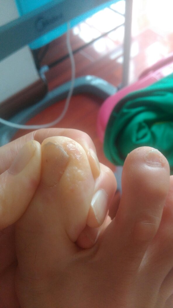 脚拇指上起了小泡泡是杂么回事?