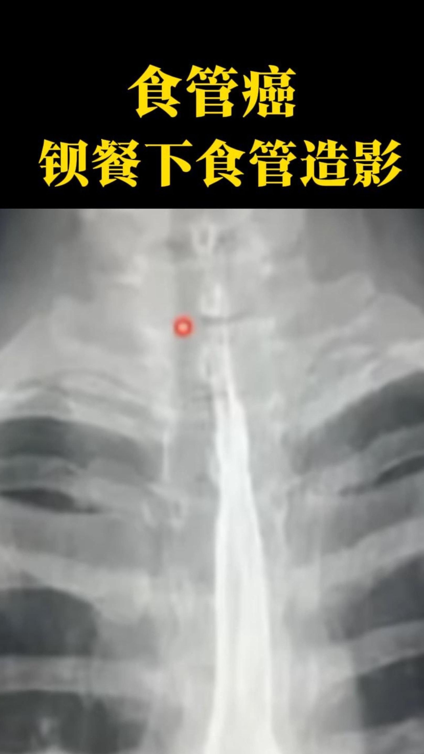 钡餐造影的操作方法是是什么