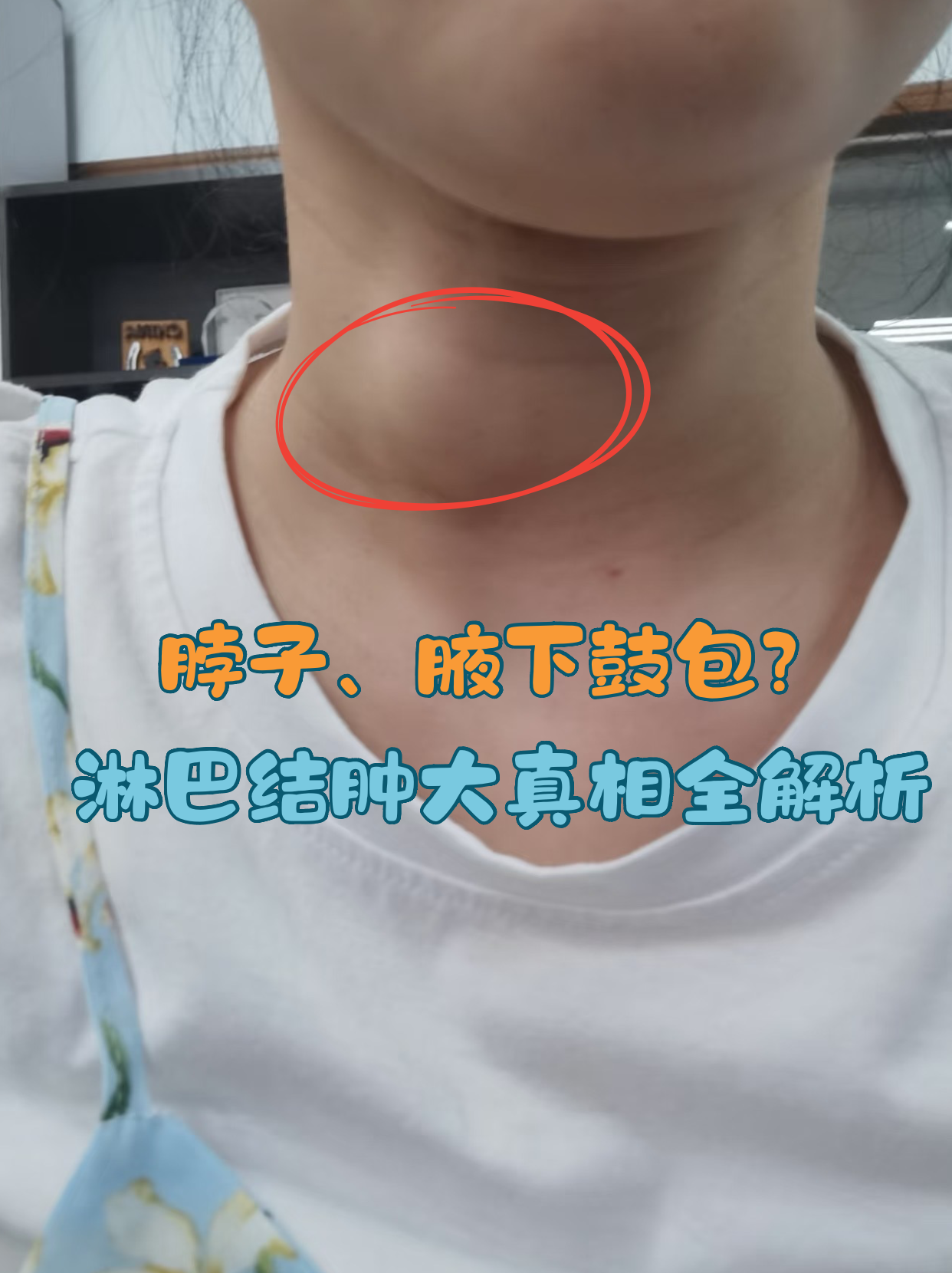 淋巴结节是怎么回事