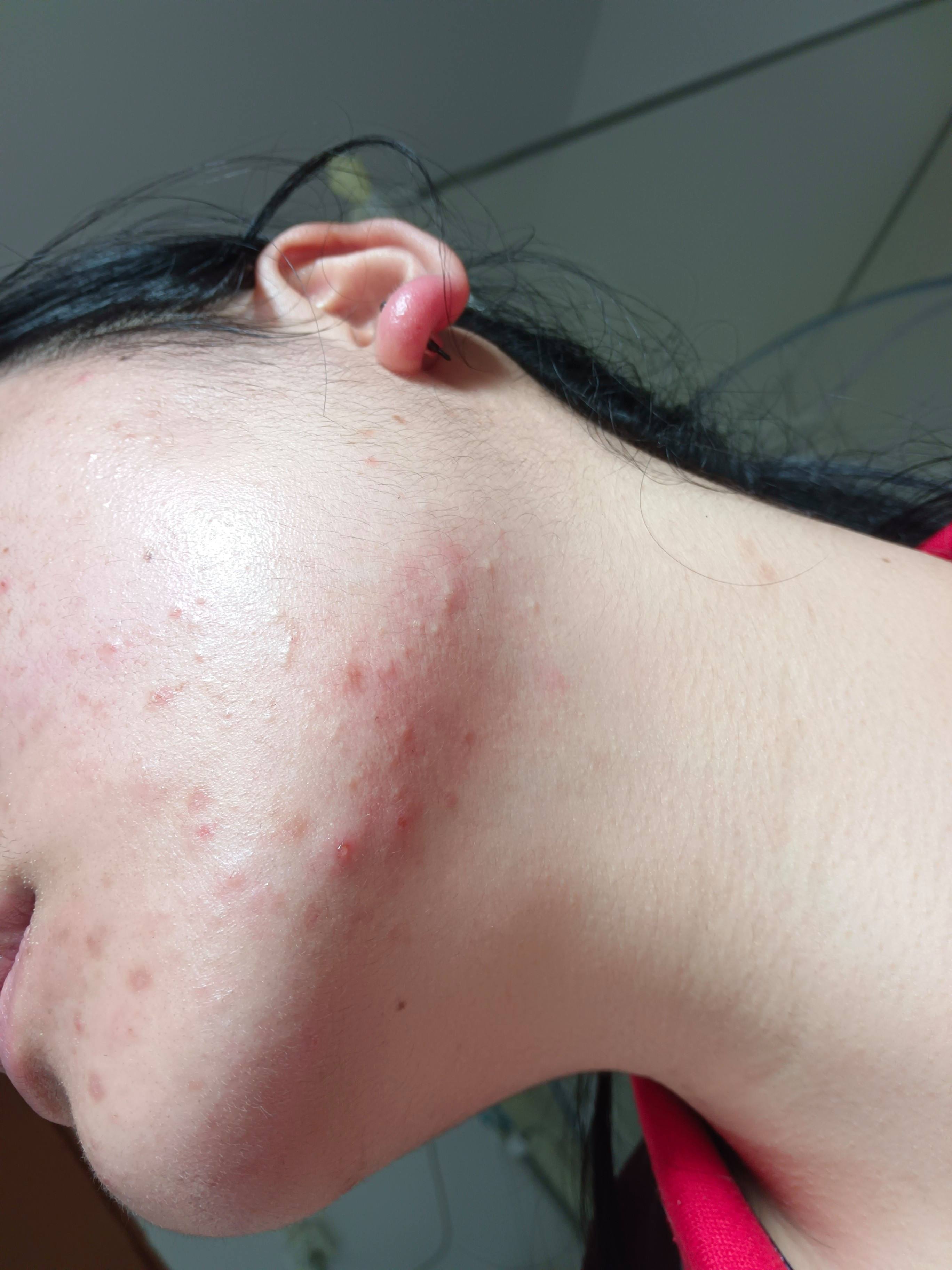 洗面奶过敏什么症状