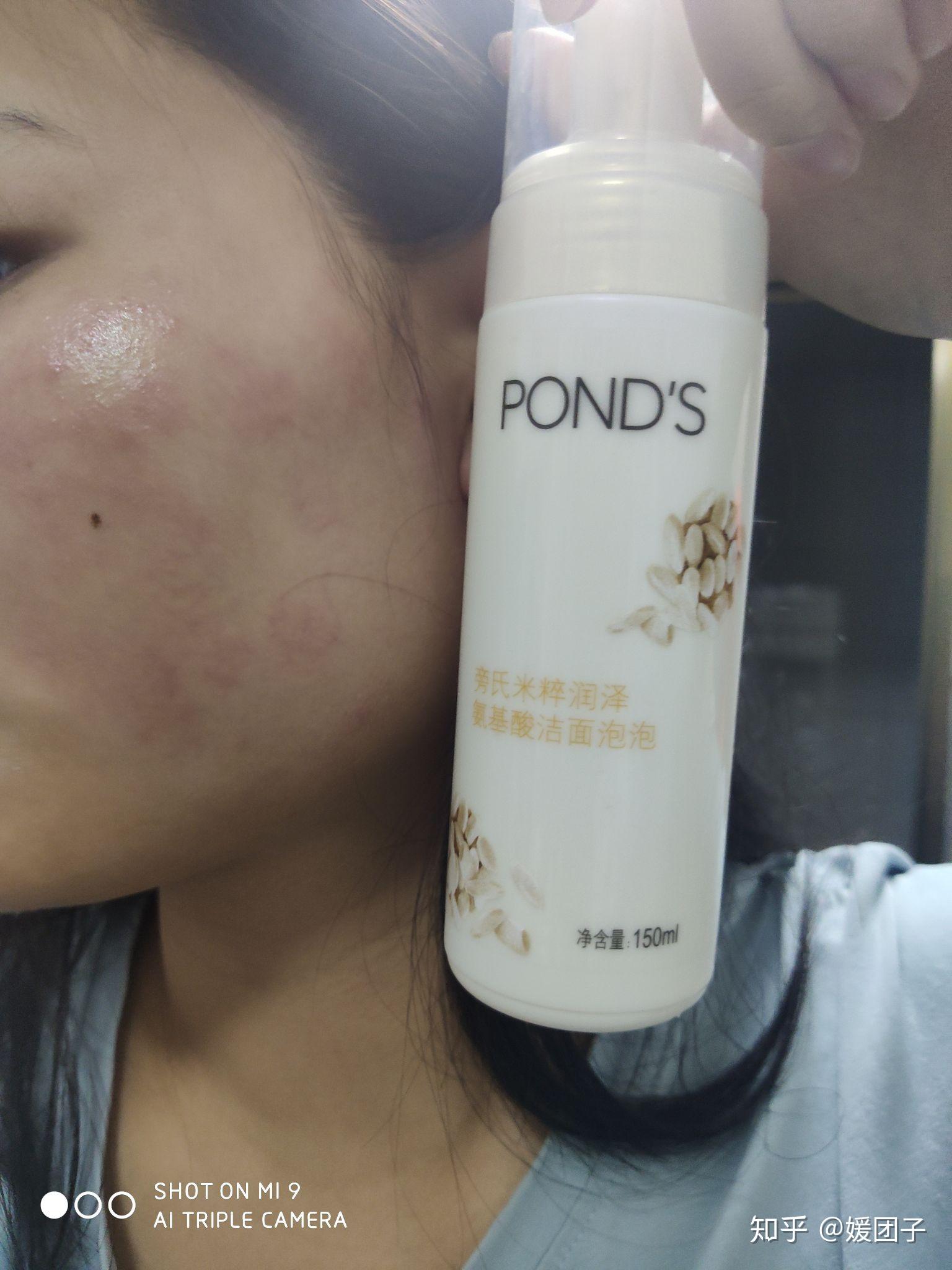 洗面奶过敏什么症状