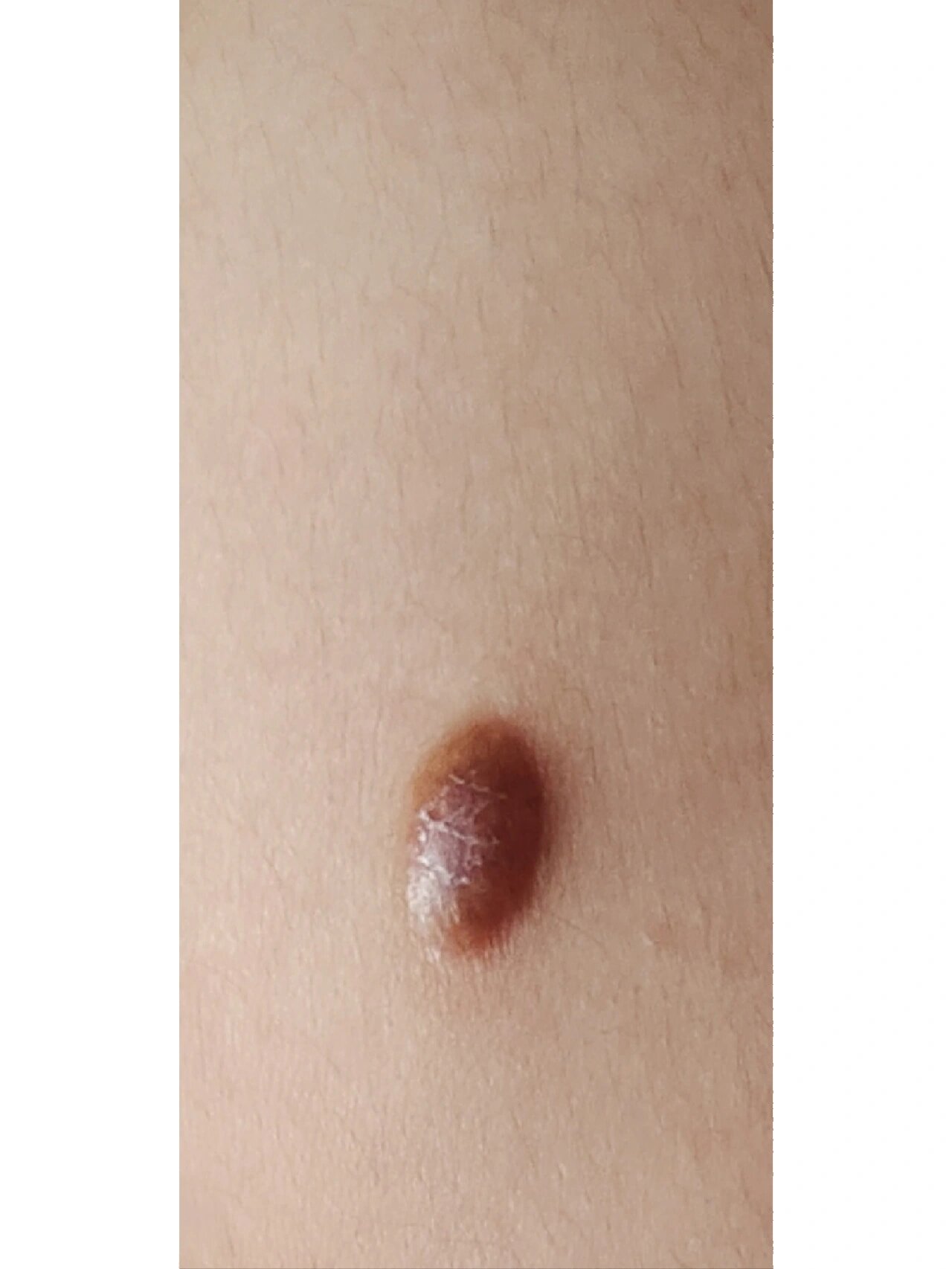 胳膊里边起了疙瘩硬硬的