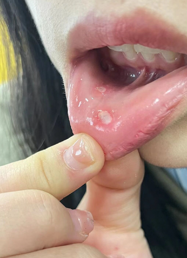 长期口腔溃疡原因有哪些