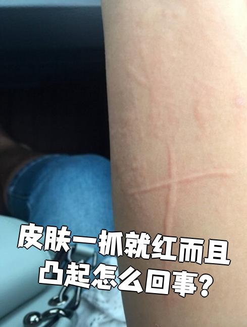 身上痒,一抓挠就红了