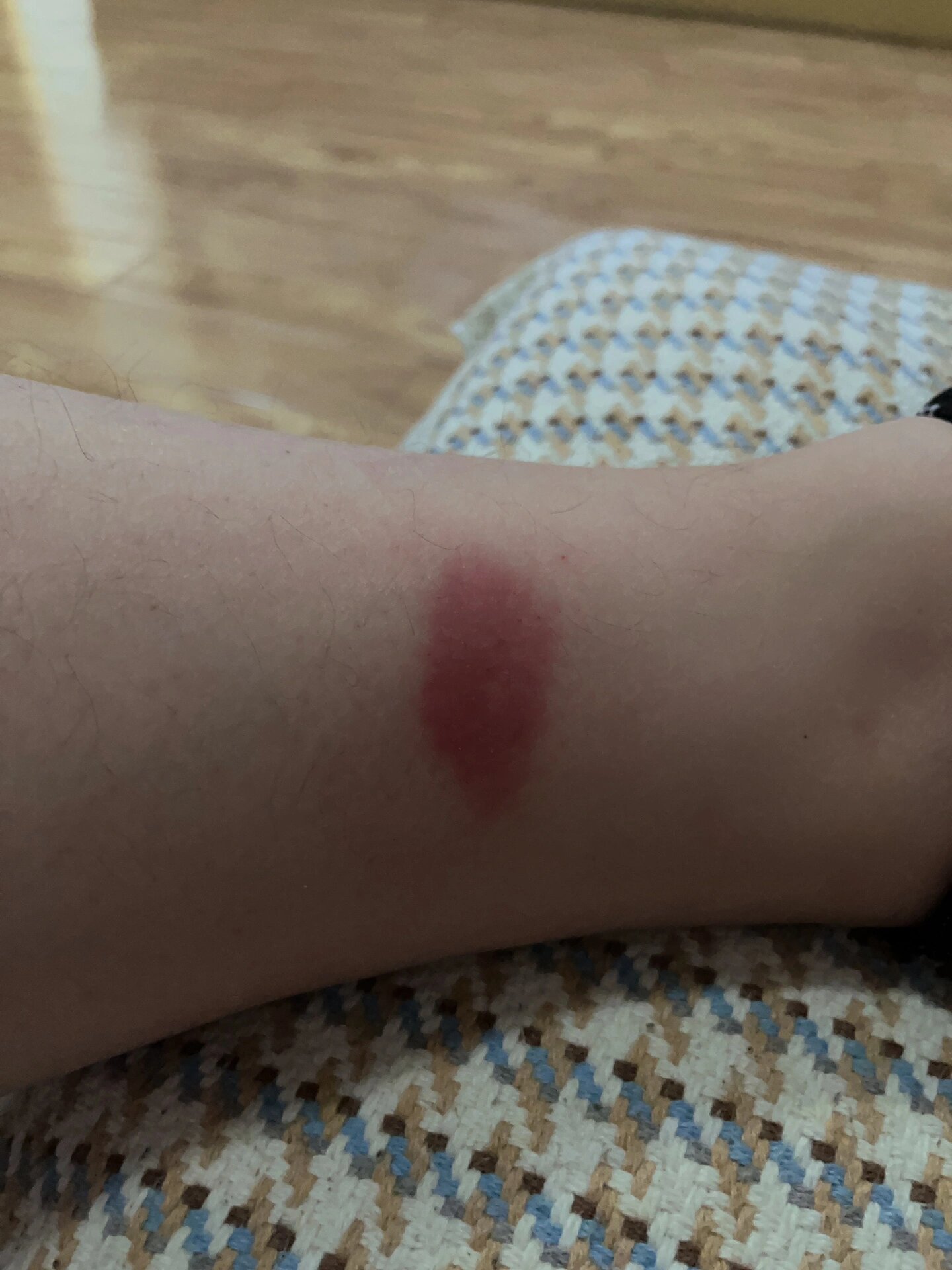 身上痒,一抓挠就红了