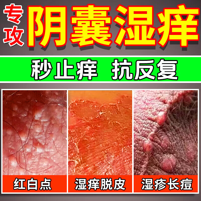 阴囊瘙痒脱皮怎么办