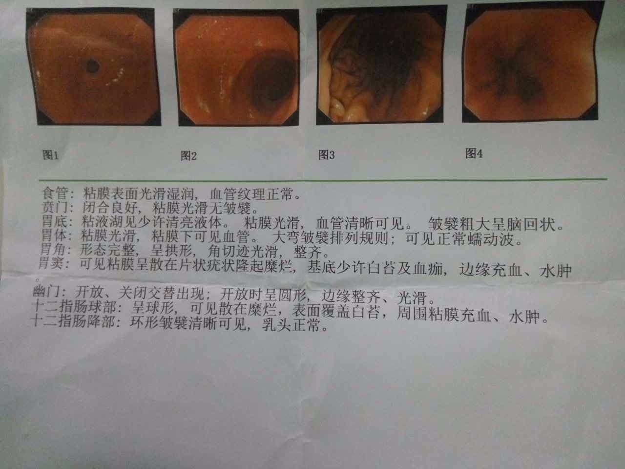 什么是慢性糜烂性胃窦炎?