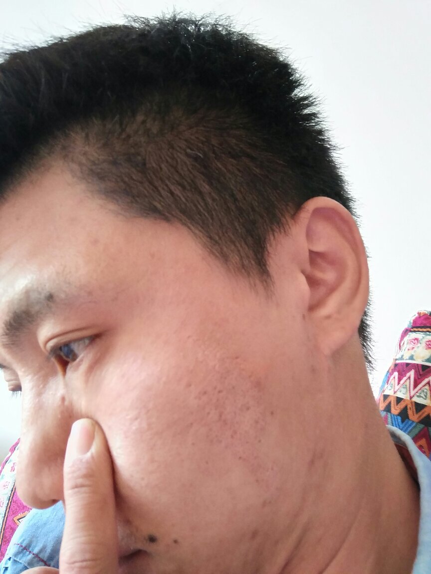 脸上起的像癣一样的白色块状,