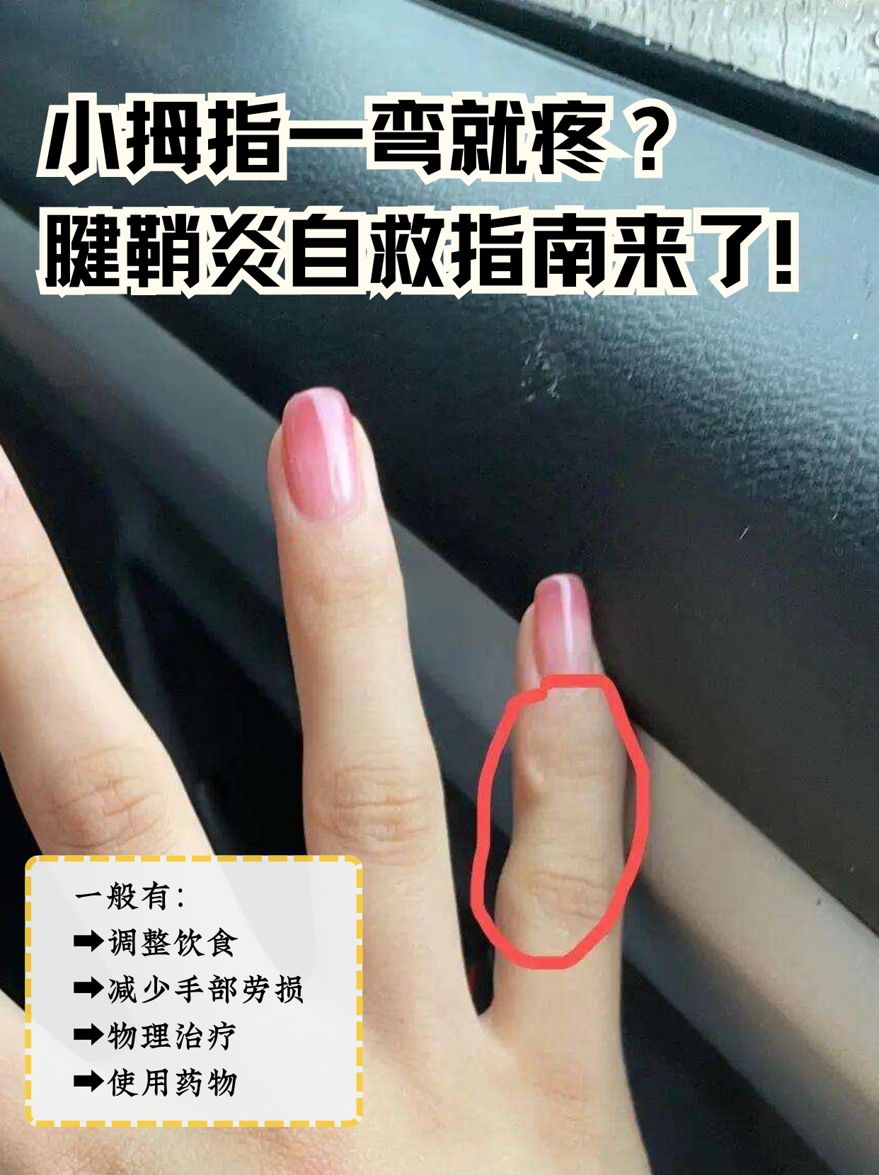 手指腱鞘炎怎么治疗?