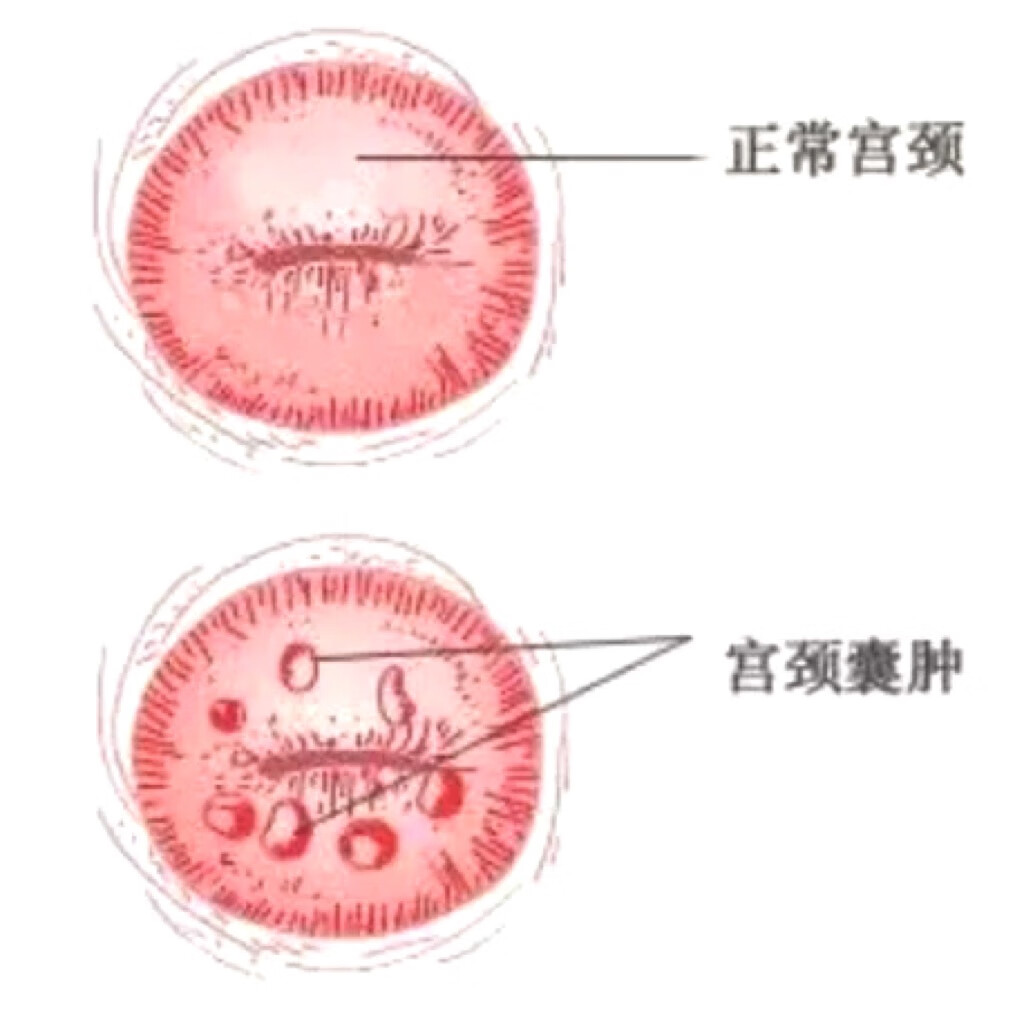 宫颈息肉手术需要住院吗?
