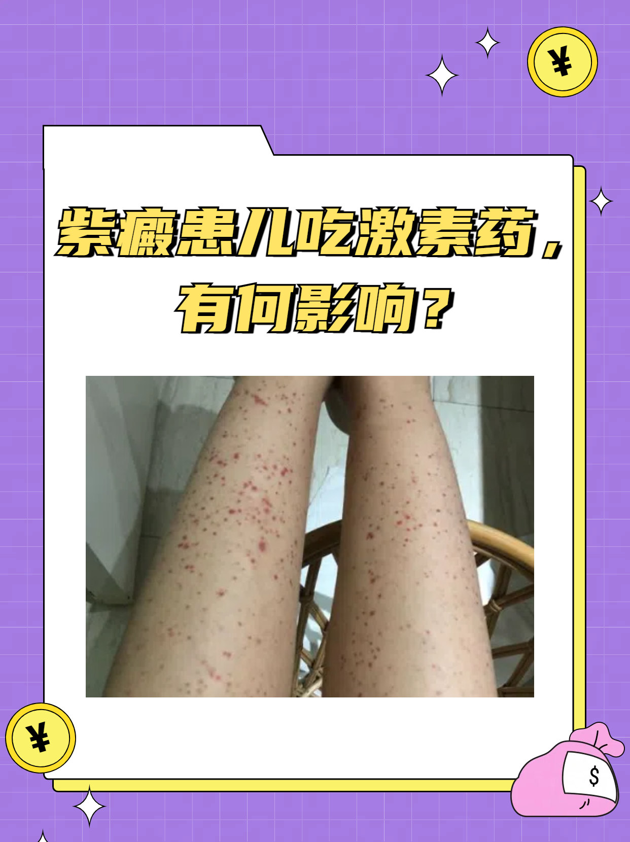 血小板减小性紫癜怎么治疗
