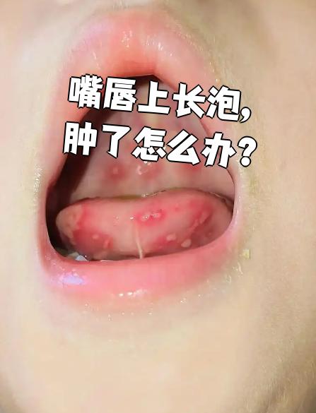 上嘴唇肿,不疼不痒,