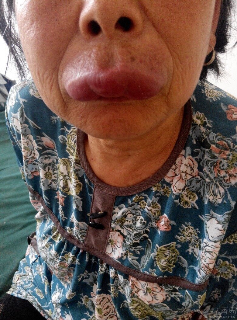 上嘴唇肿,不疼不痒,