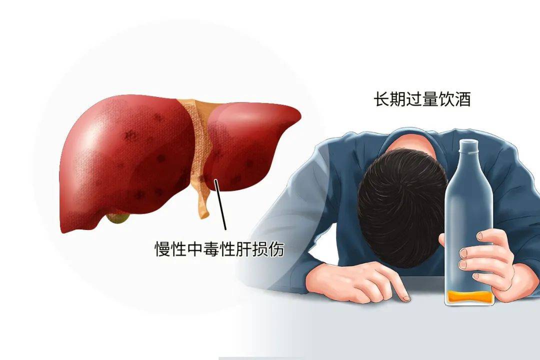 酒精肝可以治好吗