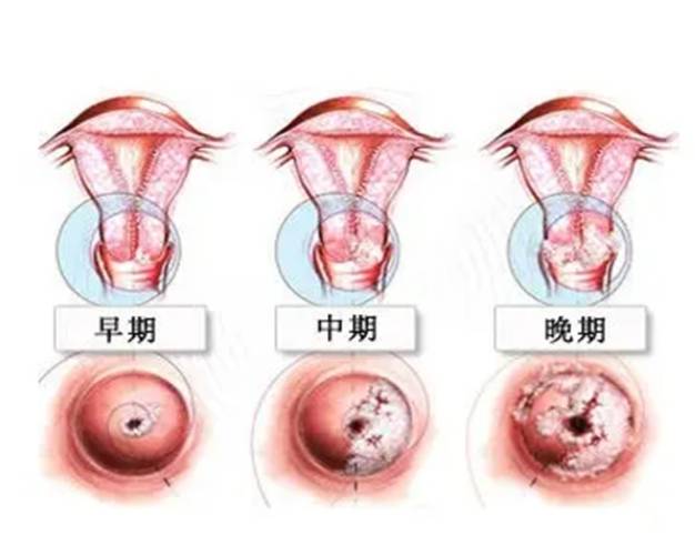 宫颈糜烂是怎么得的?