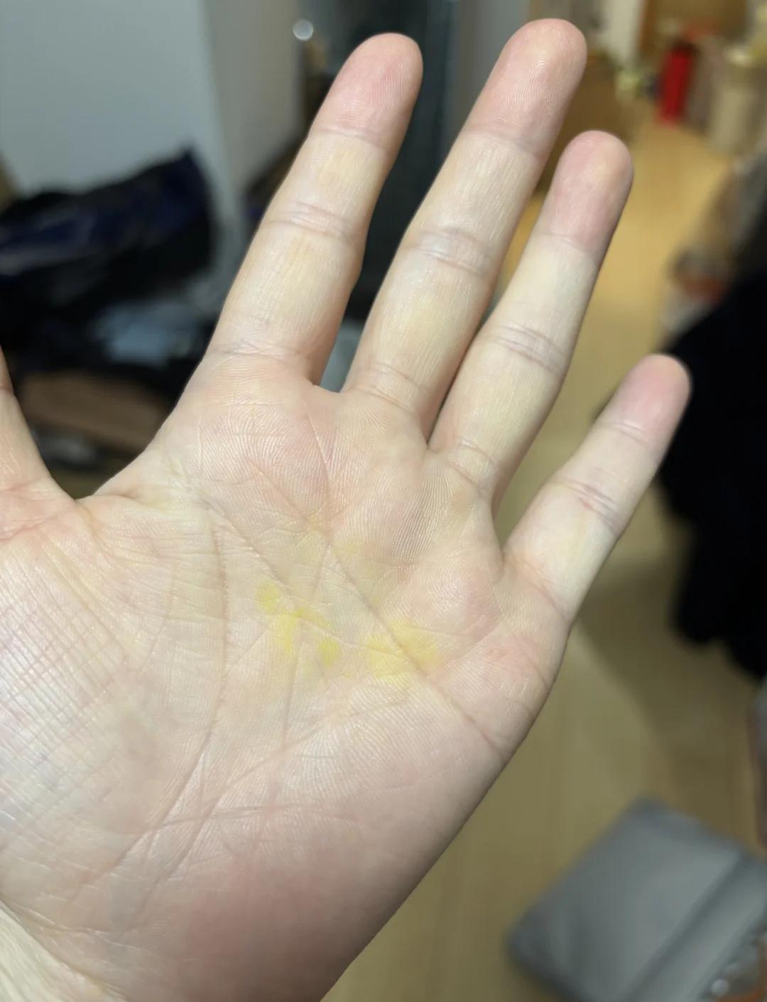 手掌泛黄是什么原因