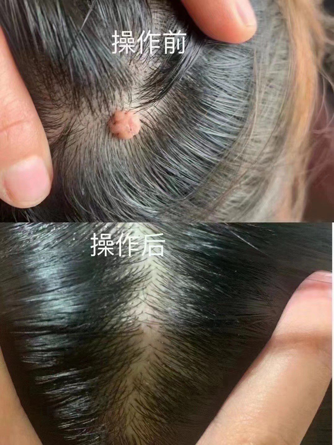 头皮上面长了一个肉疙瘩