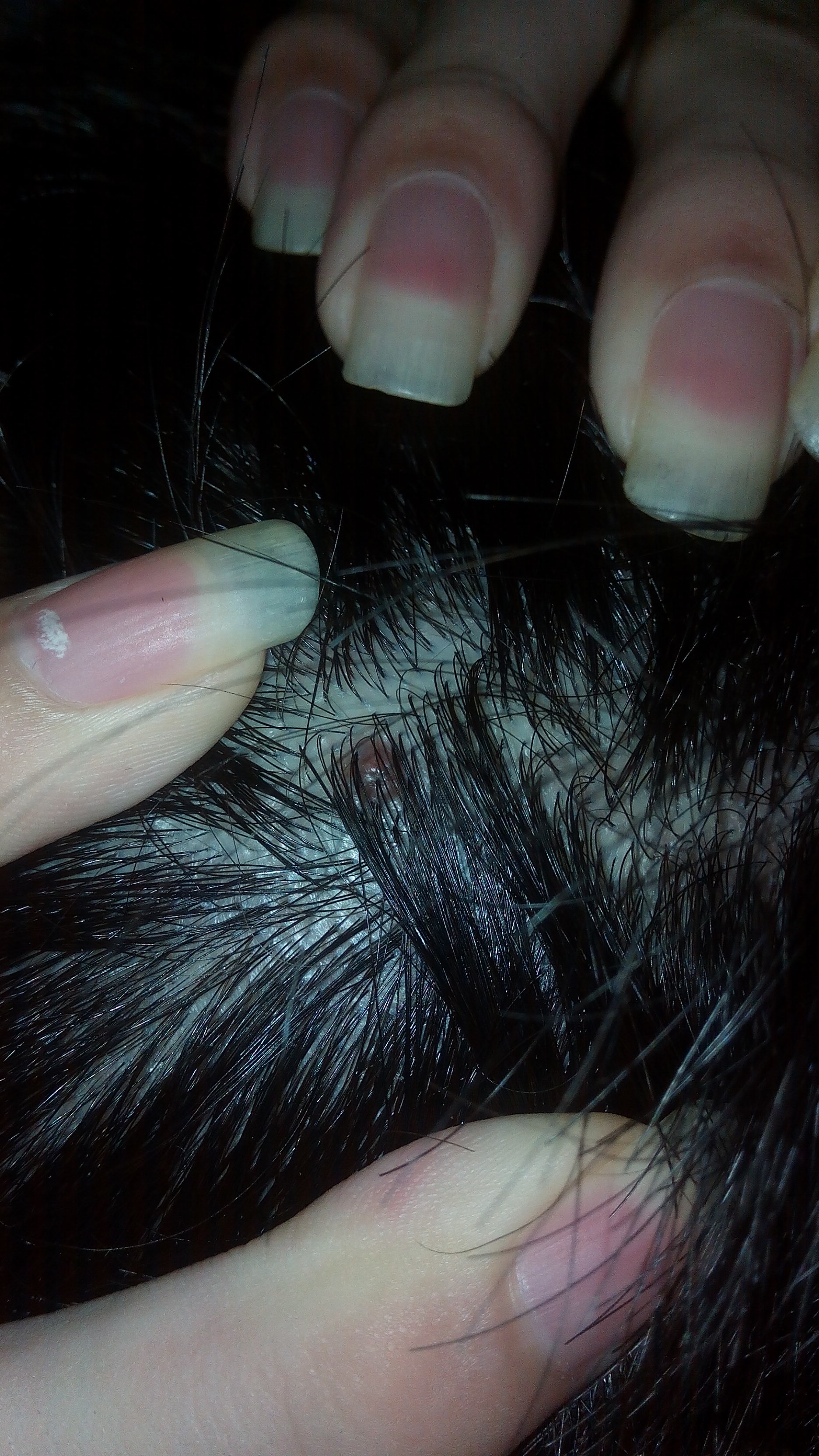 头皮上面长了一个肉疙瘩