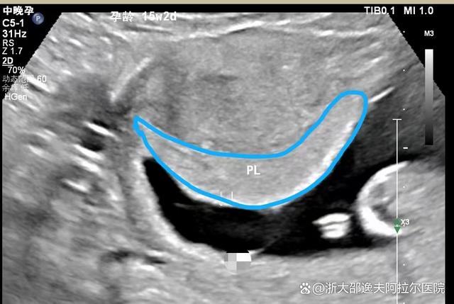 什么是胎盘早熟?