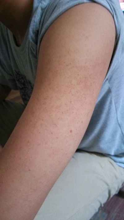 毛周角化症是什么