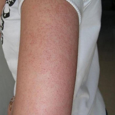 毛周角化症是什么