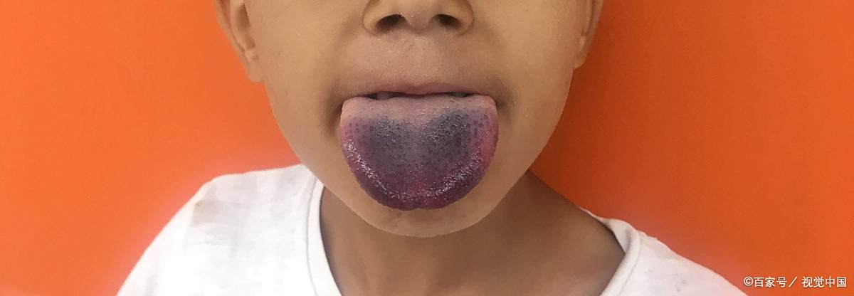 舌苔发黑的原因及治疗