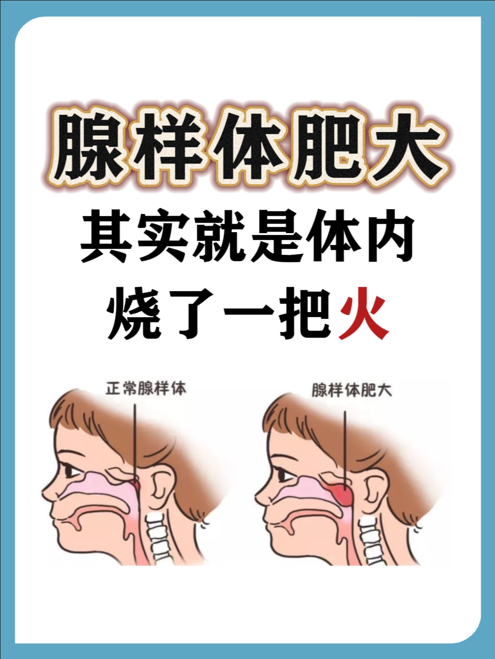 腺样体肥大的原因有哪些