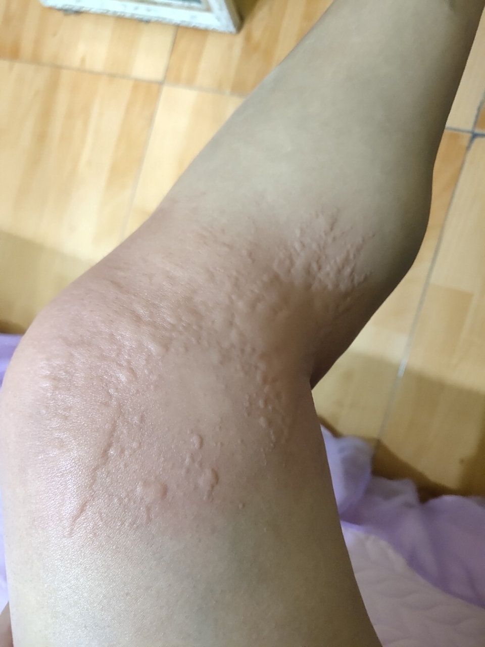 身上瘙痒,感觉虫子爬动