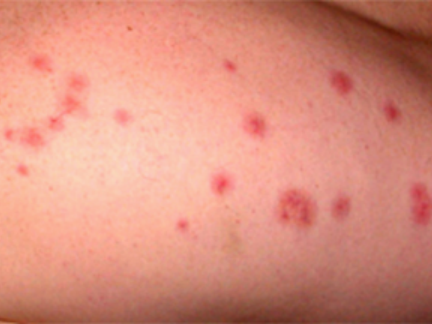 身上瘙痒,感觉虫子爬动