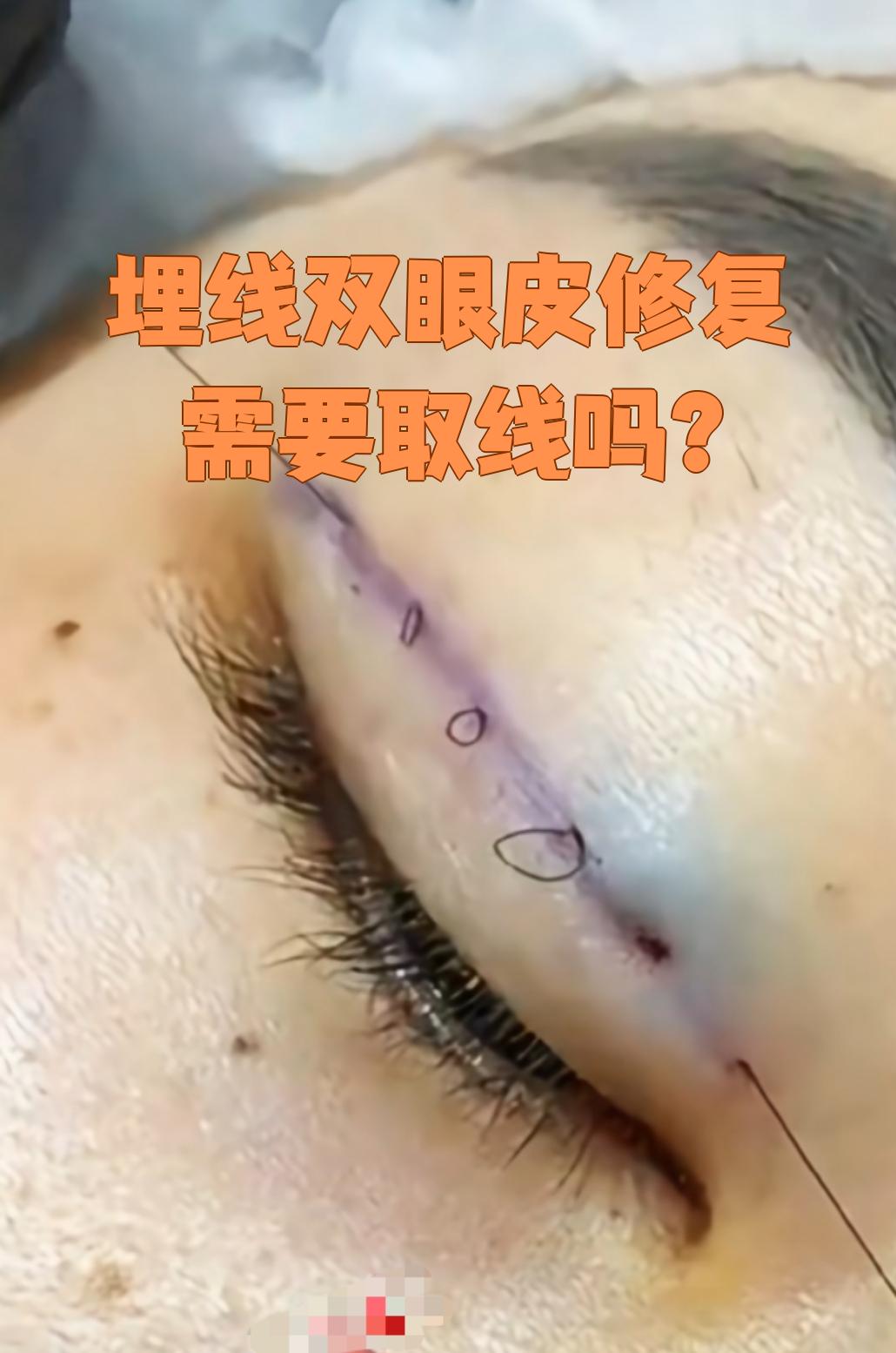 埋线双眼皮多久能消肿?