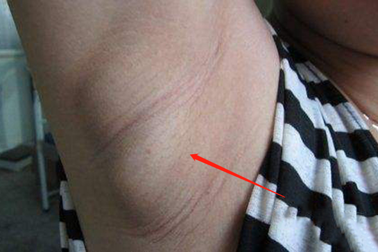 腋下长了一颗很痘痘有点像的一个脓包