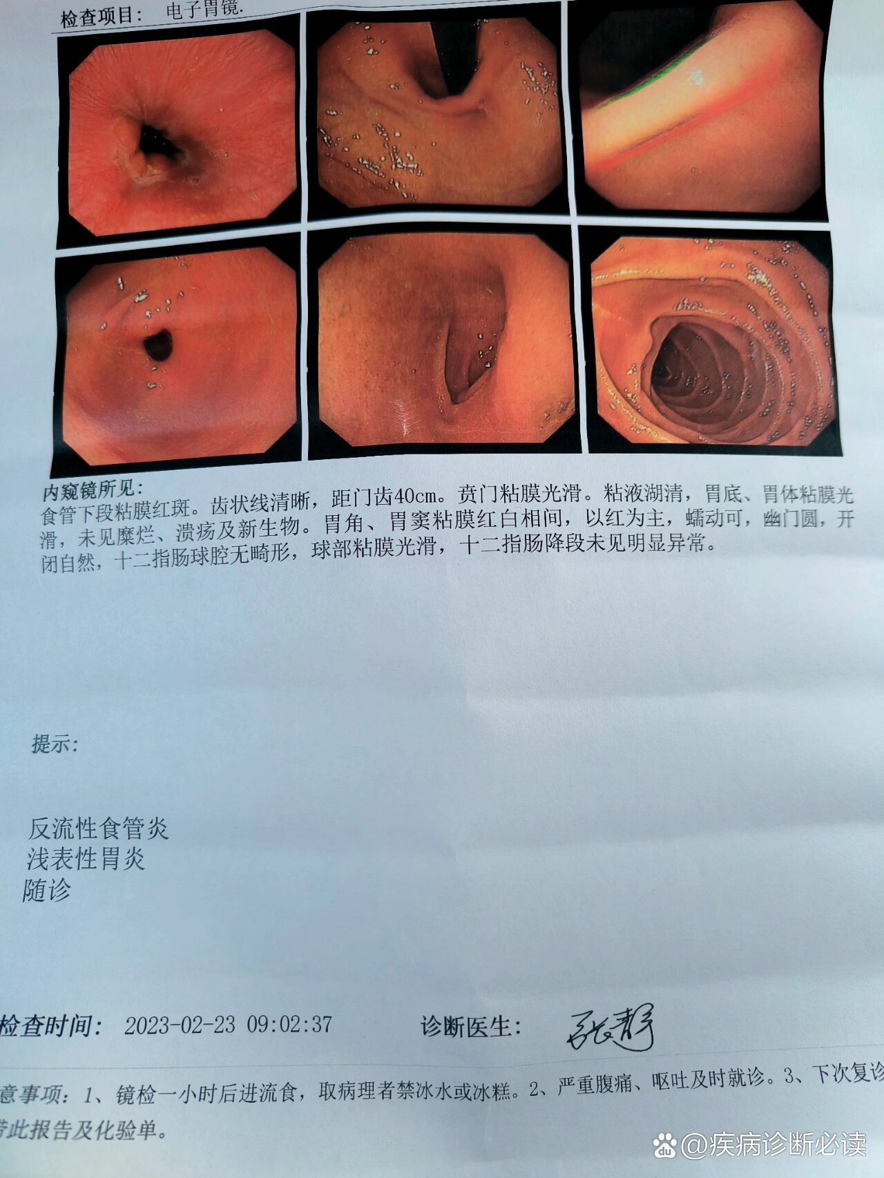 食管炎的症状能自愈吗