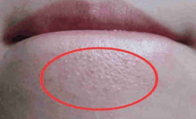 尿道口有白色分泌物是怎么回事?