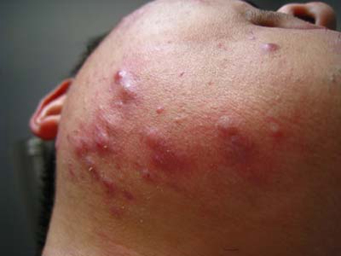 什么是结节性痤疮?