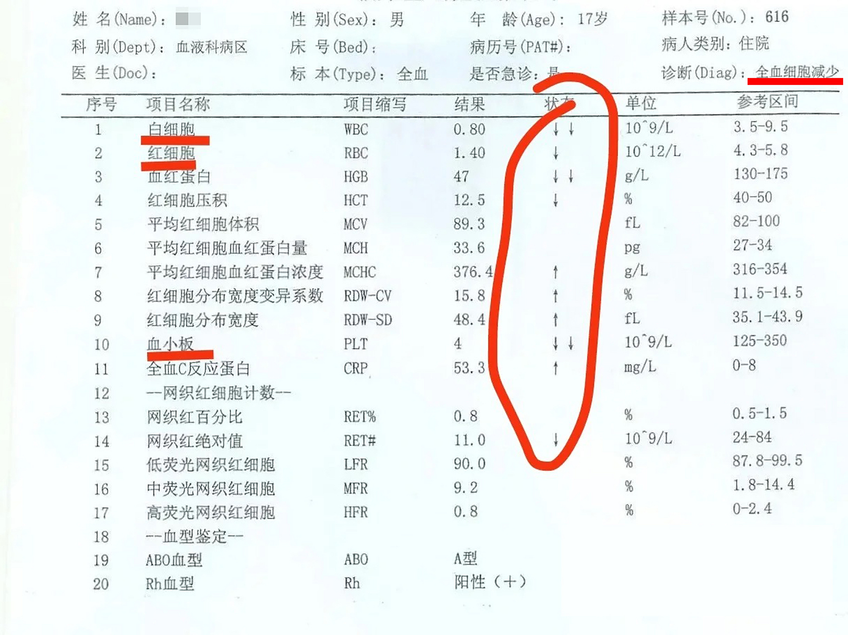小儿白血病初期血常规