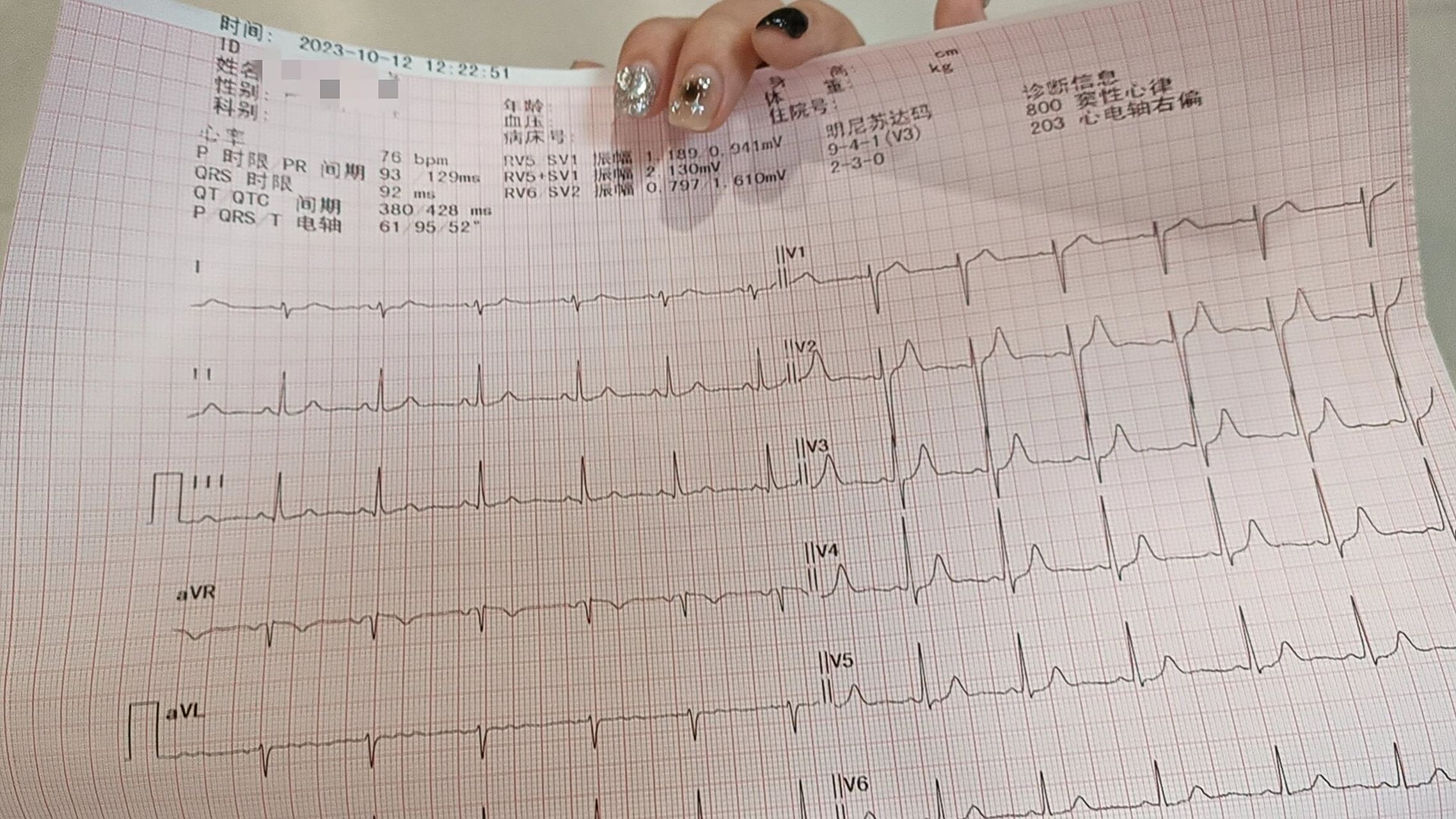 窦性心律心电轴右偏什么意思