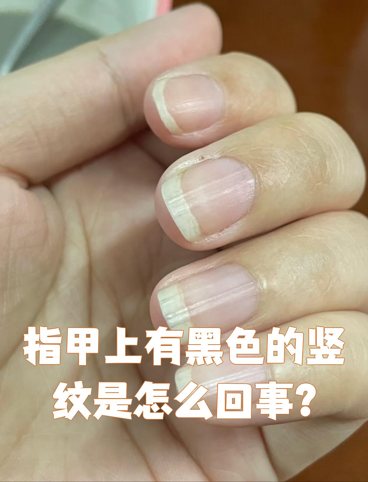 手指甲有竖纹是病吗?